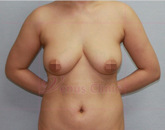 가슴축소 지방흡입 정면(팔올린자세) 수술 전 — 비너스의원