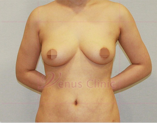 가슴축소 지방흡입 정면(팔올린자세) 수술 후 — 비너스의원
