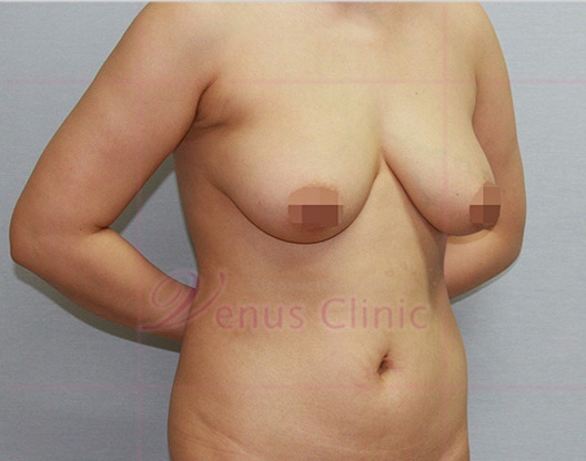 가슴축소 지방흡입 사면 수술 전 — 비너스의원