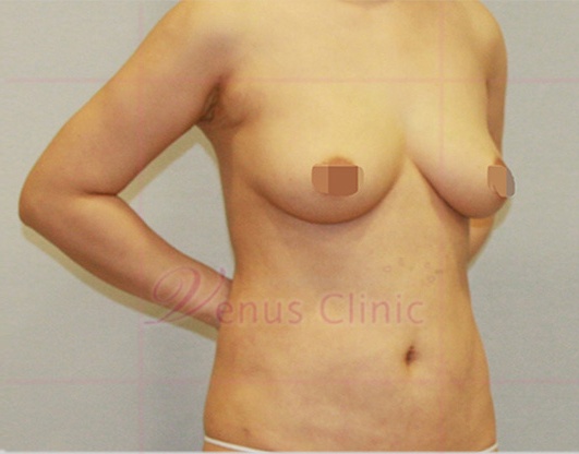 가슴축소 지방흡입 사면 수술 후 — 비너스의원