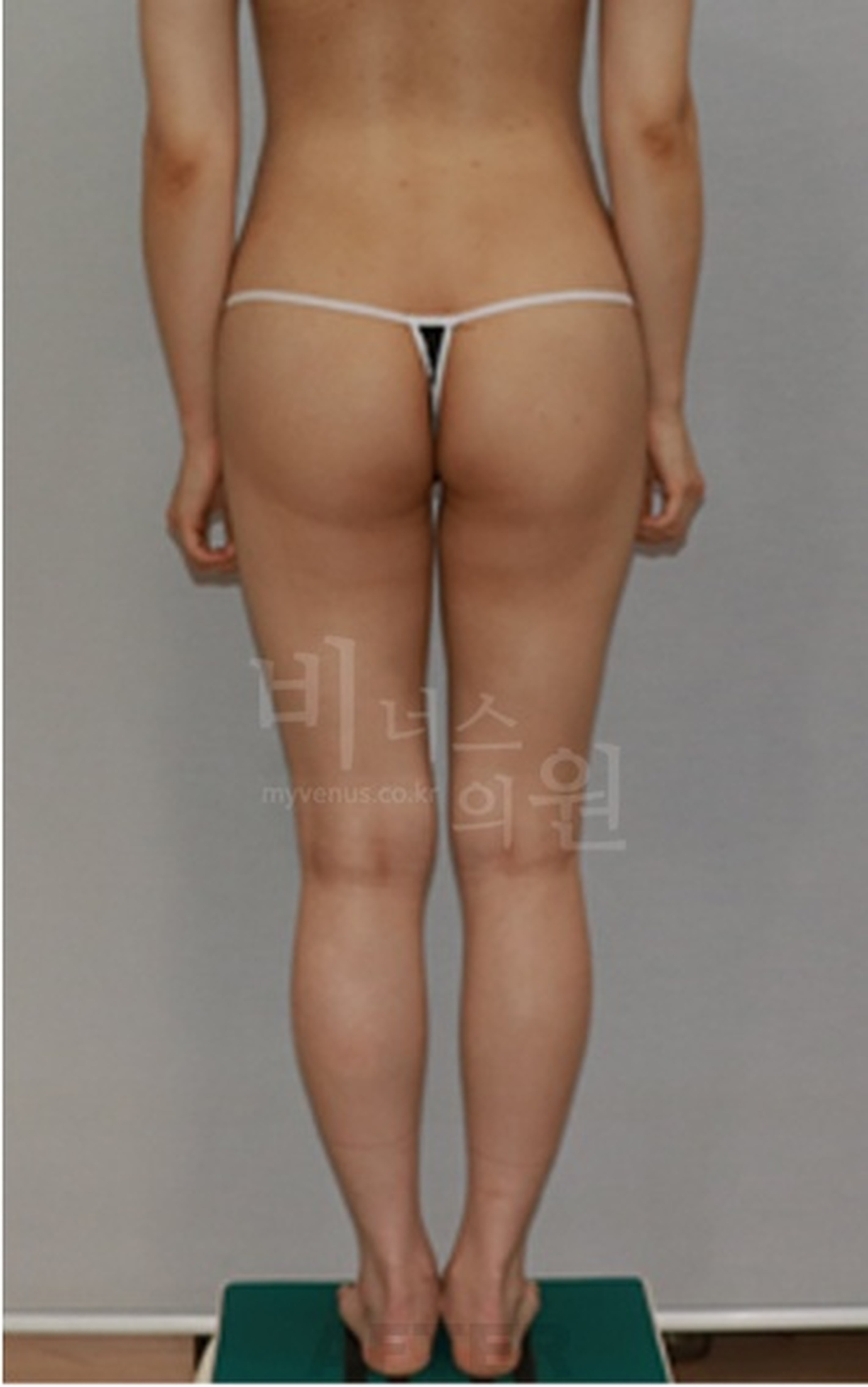 엉덩이 지방흡입 수술 후 후면