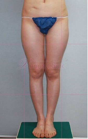 엉덩이 지방흡입 수술 전 정면