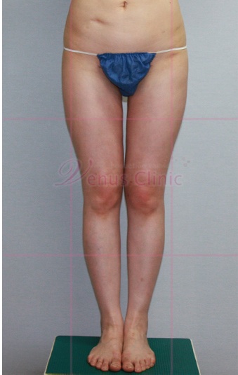 엉덩이 지방흡입 수술 후 정면