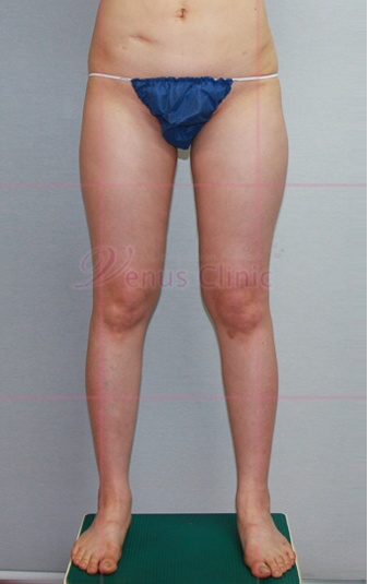 엉덩이 지방흡입 수술 전 측면