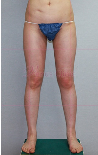 엉덩이 지방흡입 수술 후 측면