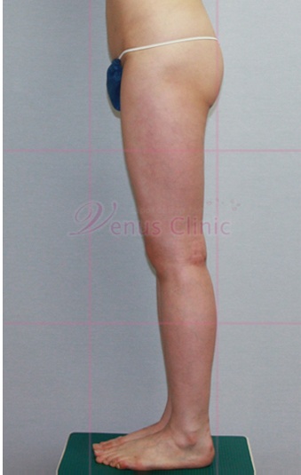 엉덩이 지방흡입 수술 후 후면