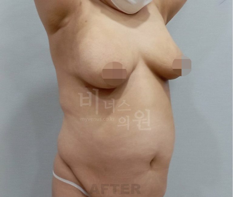 가슴축소 수술 비용과 방법 비교 — 지방흡입 유방축소 선택 가이드