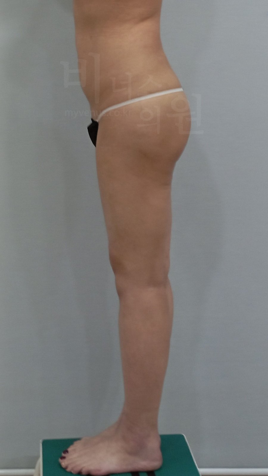 엉덩이 지방흡입 수술 후 1주 우측면