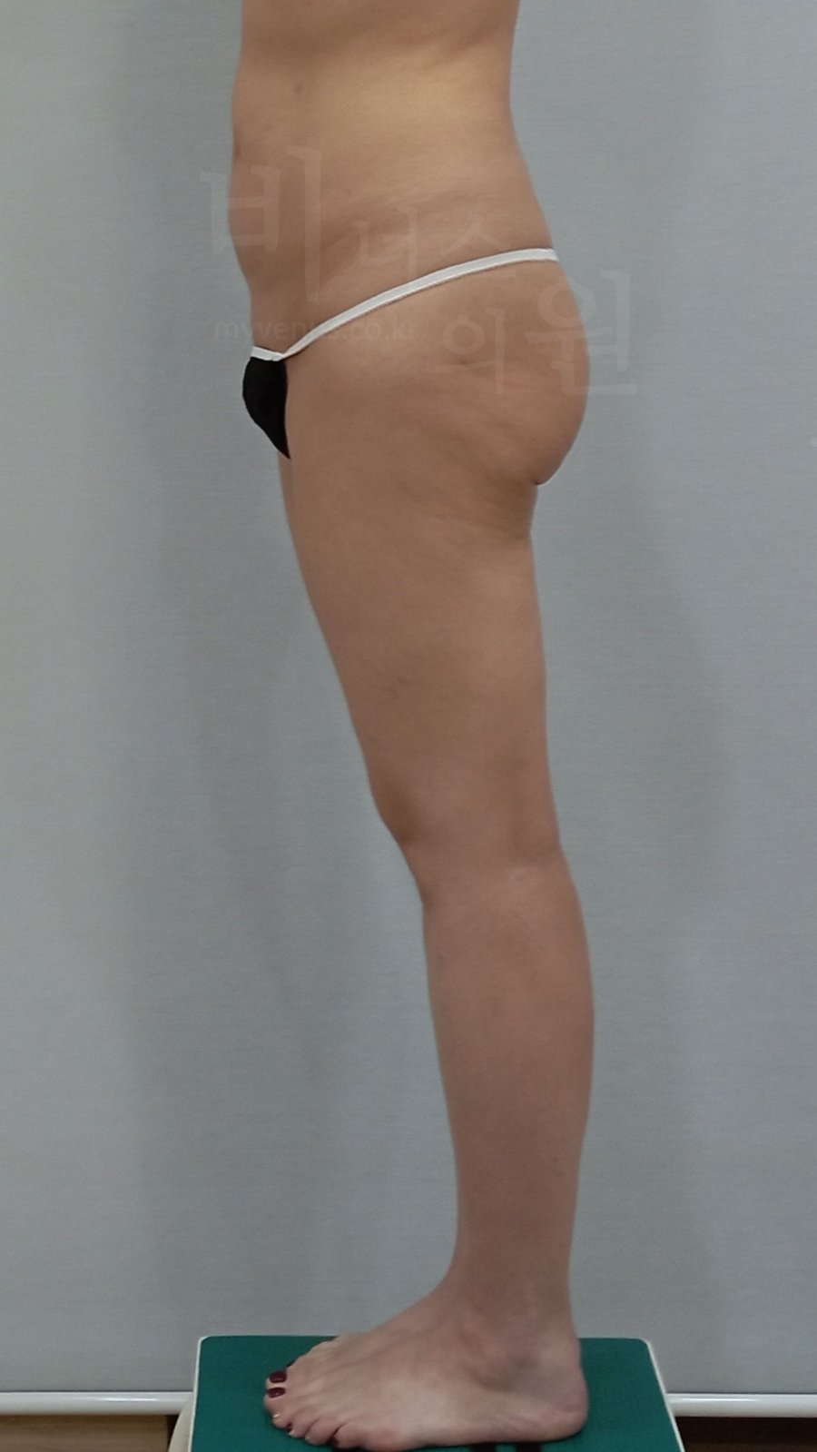 엉덩이 지방흡입 수술 전 우측면