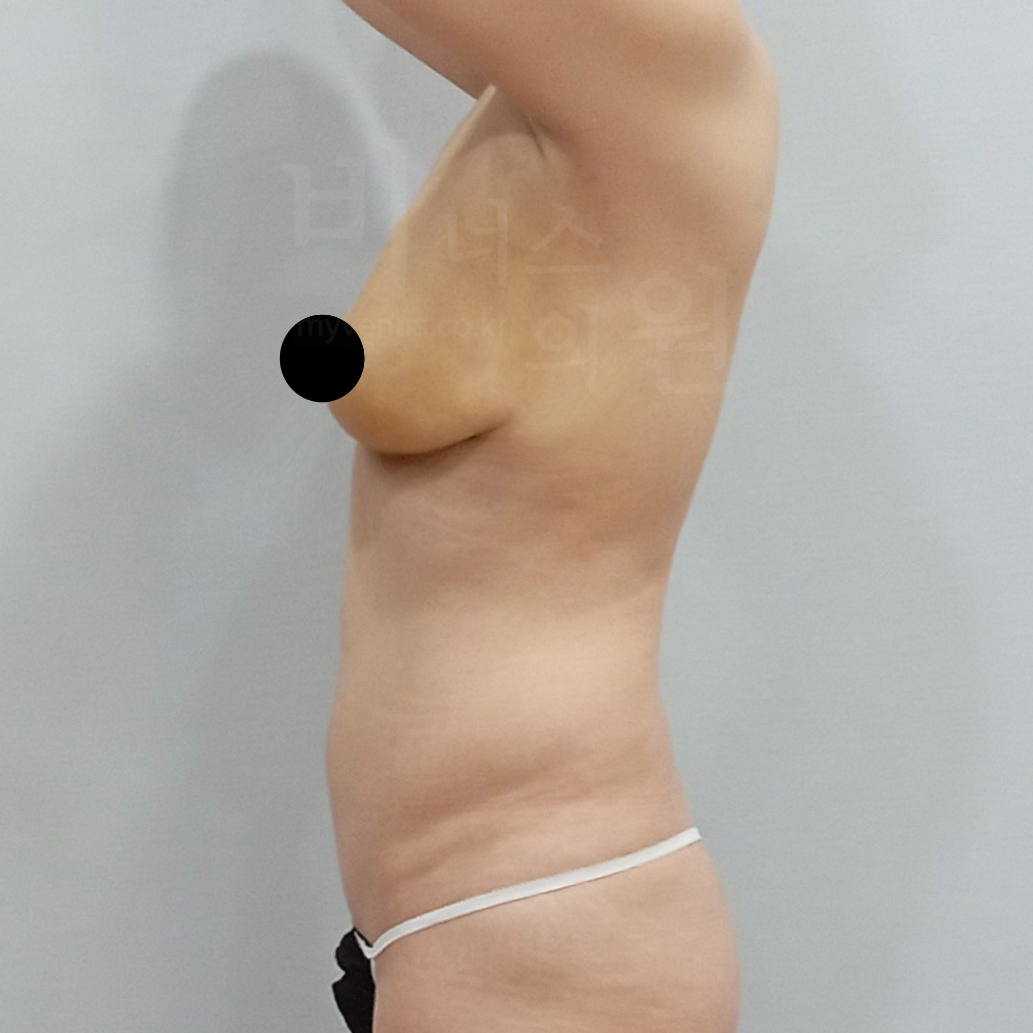 가슴축소 지방흡입 수술 후 측면 — 처짐 개선 및 유방 라인 상승