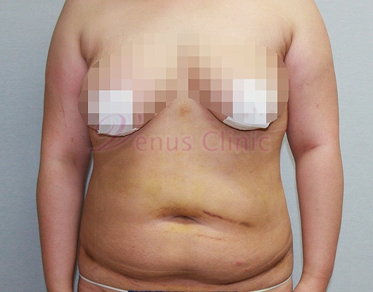 복부지방흡입 병원 선택, 이 5가지는 꼭 확인하세요