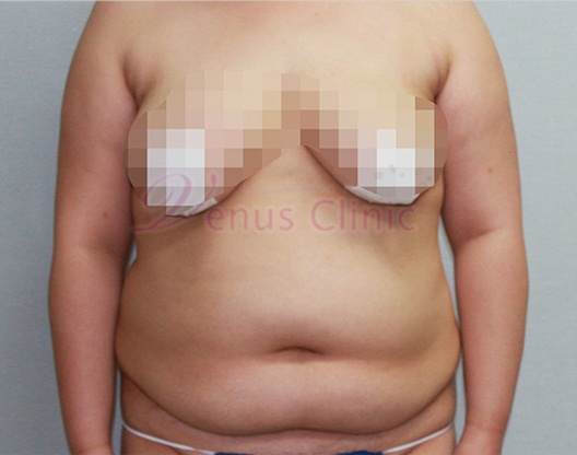 복부지방흡입 재수술 수술 전 정면