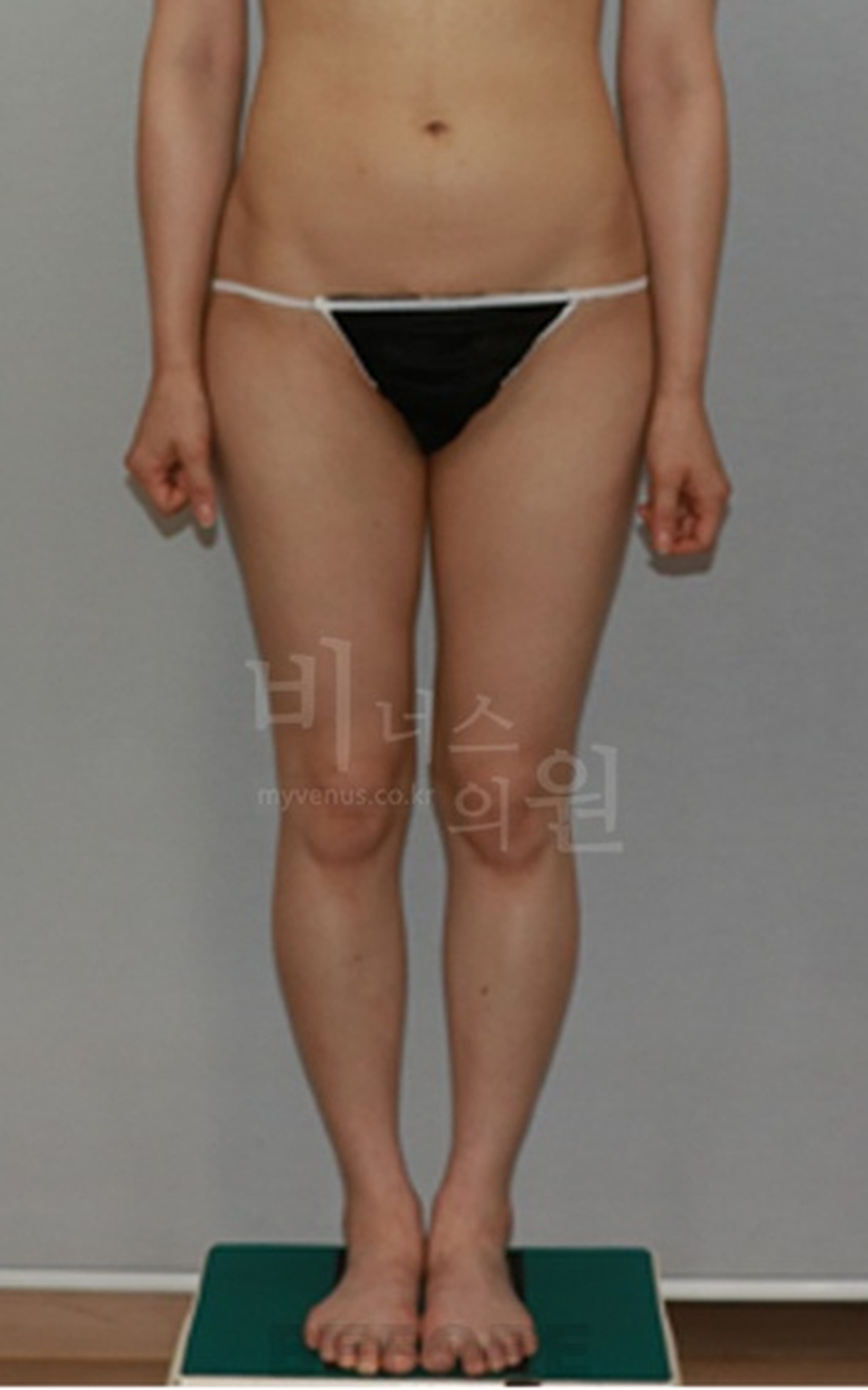 엉덩이 볼륨업 지방흡입 수술 전 정면