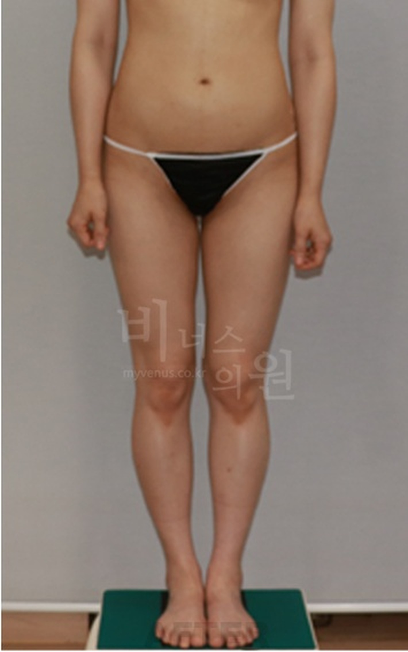 엉덩이 볼륨업 지방흡입 수술 후 정면