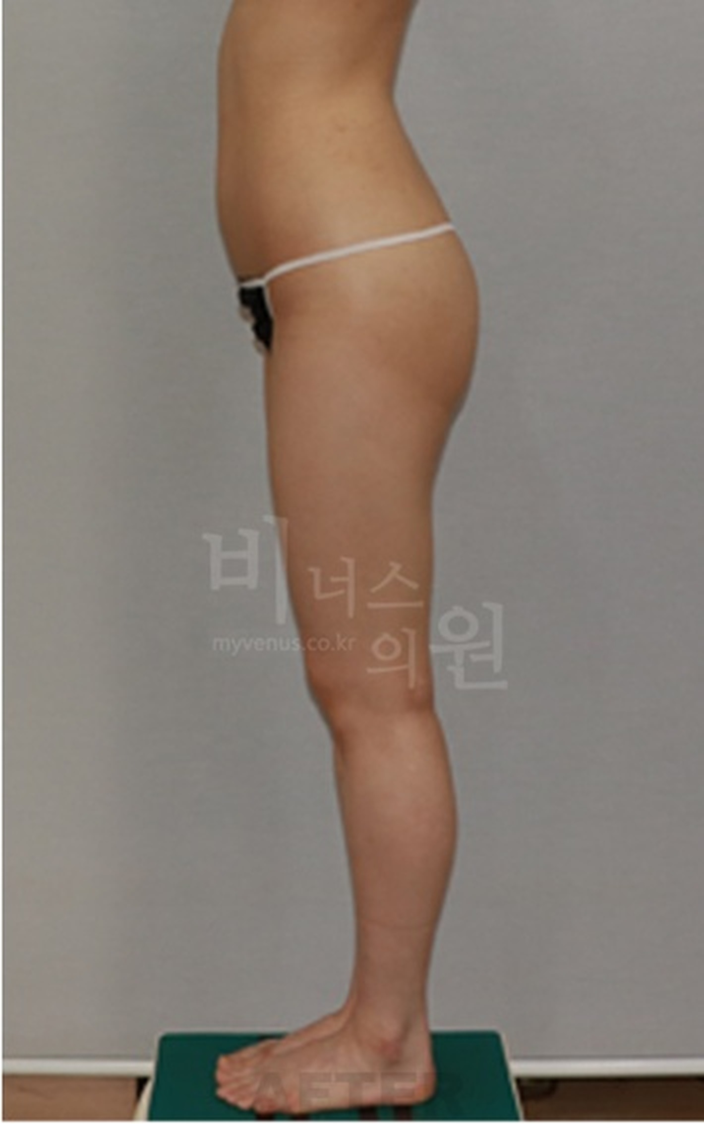 엉덩이 볼륨업 지방흡입 수술 후 측면