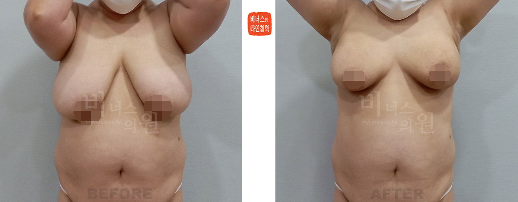가슴축소 지방흡입 결과 — 지방 비율 높은 경우 충분한 볼륨 감소