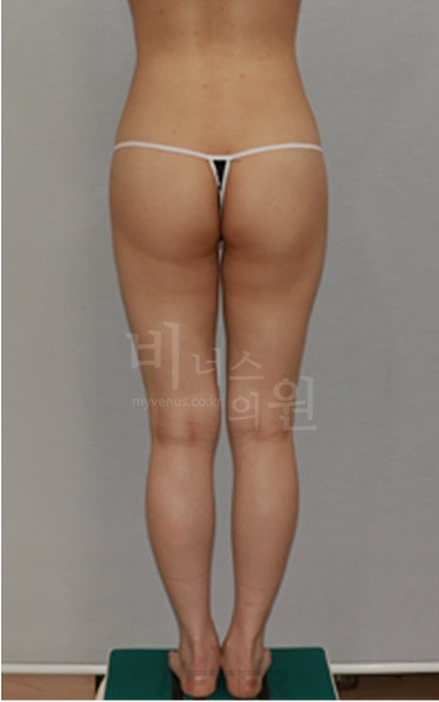 엉덩이축소 지방흡입 수술 후 후면