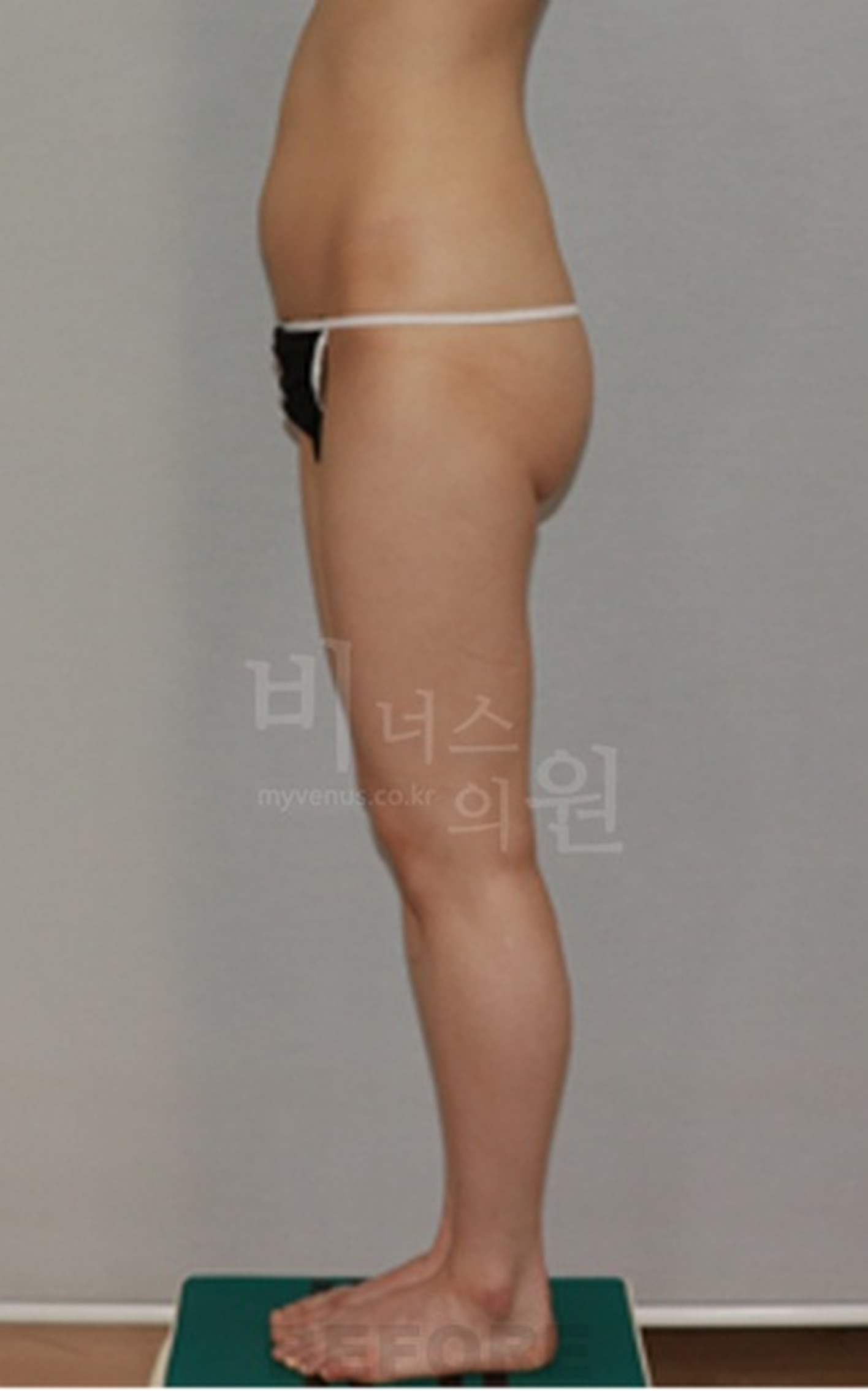엉덩이축소 지방흡입 수술 전 우측면