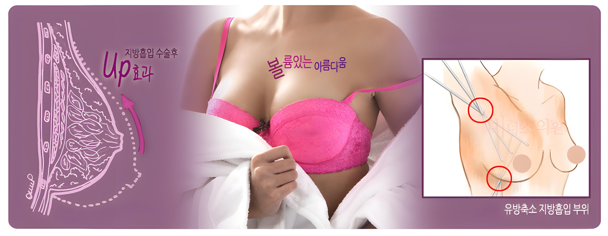 가슴축소 지방흡입 — 투메슨트 방식 미세절개 흉터 없는 가슴축소 방법