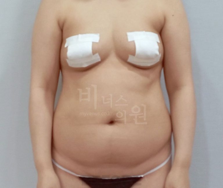 복부지방흡입 비용, 제대로 알고 선택하는 방법