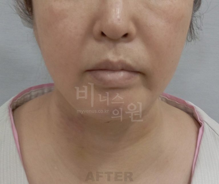 턱지방흡입 나에게 맞을까? — 비용·적합성·선택 가이드