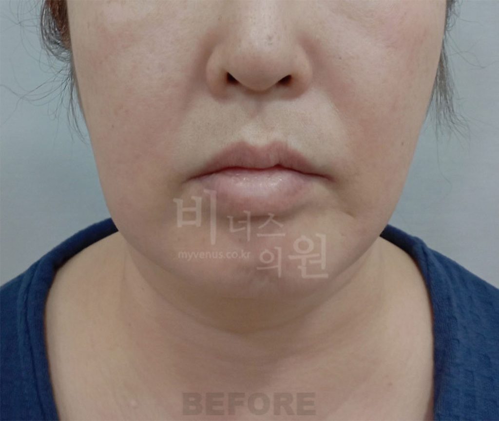 이중턱 목 지방흡입 수술 전 정면