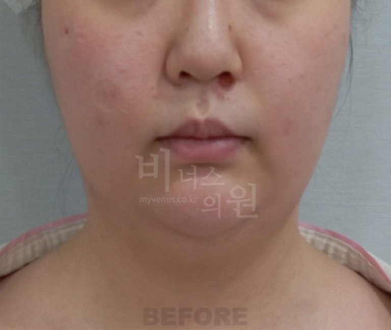 턱밑 지방흡입, 붓기는 얼마나? 비용과 회복 기간 완전 정리