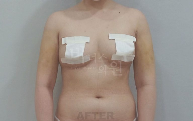 팔뚝지방흡입 비용이 다를 수밖에 없는 이유 — 수술량·방법으로 알아보는 선택 가이드