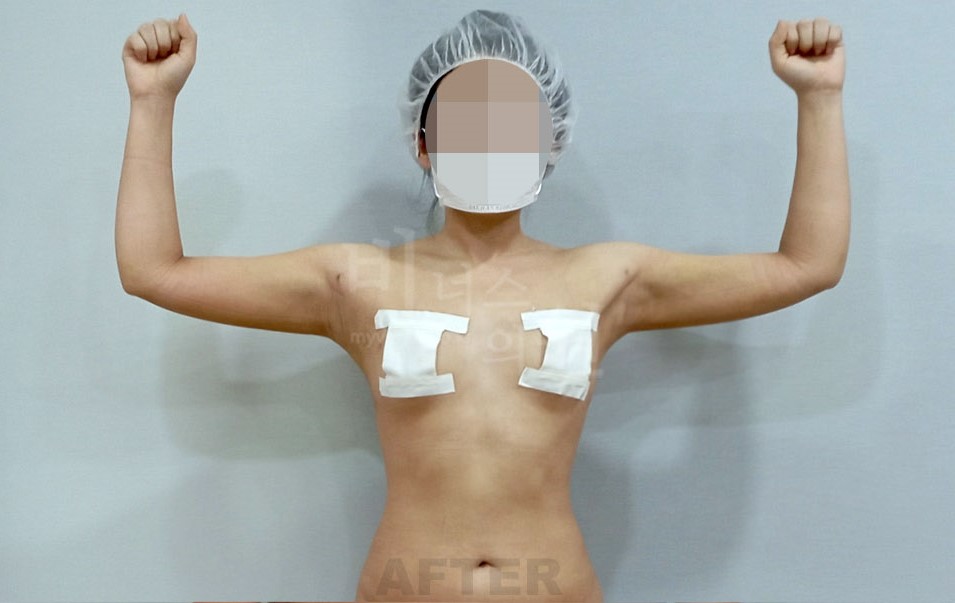 팔뚝 지방흡입 수술 후 정면