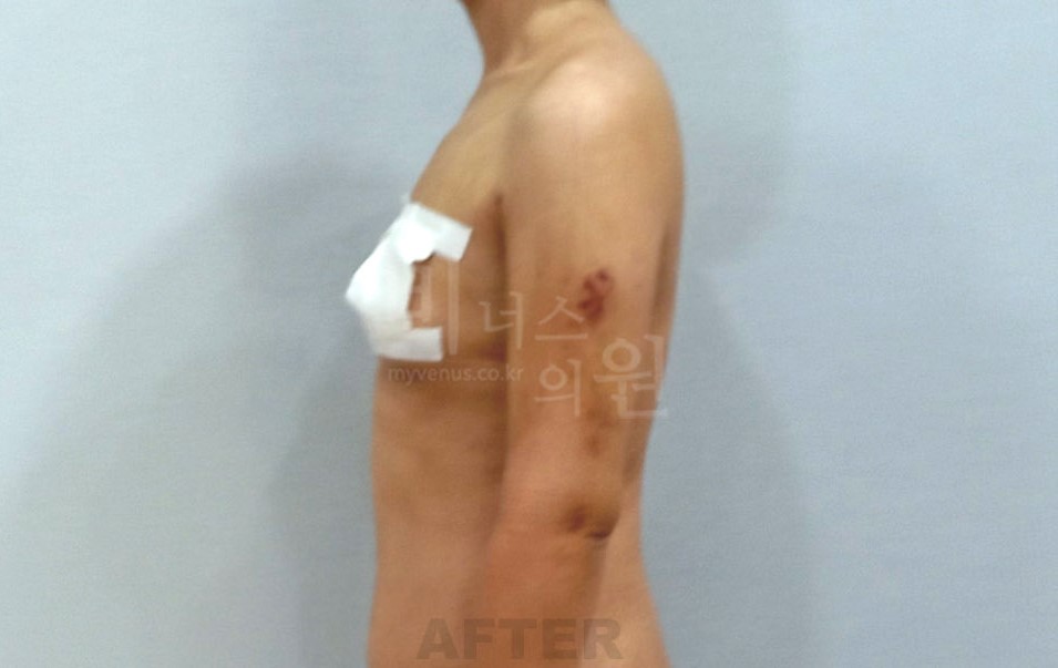 팔뚝 지방흡입 수술 후 우측면