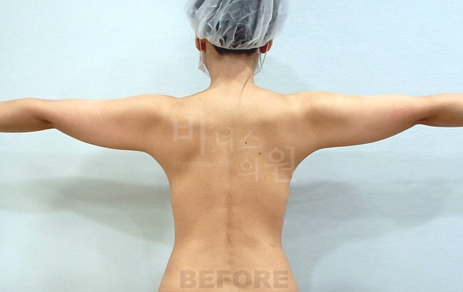 팔뚝 지방흡입 수술 전 후면