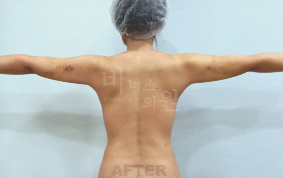 팔뚝 지방흡입 수술 후 후면
