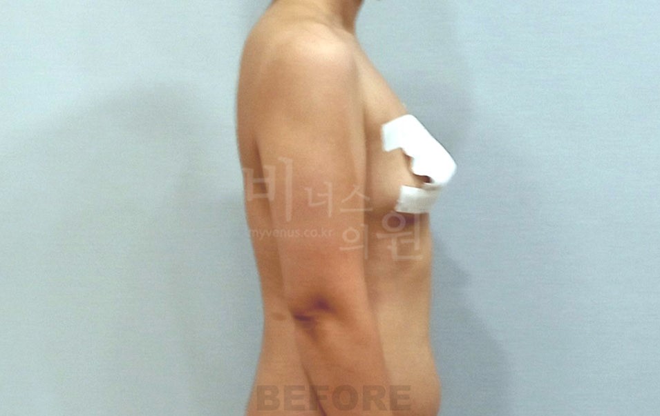 팔뚝 지방흡입 수술 전 좌측면