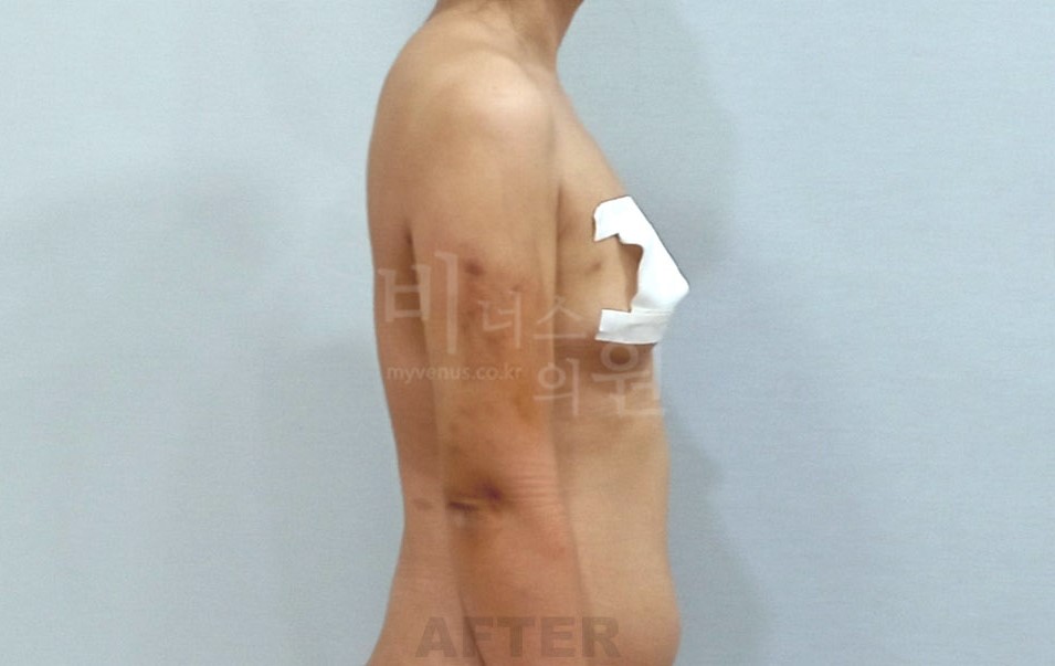 팔뚝 지방흡입 수술 후 좌측면