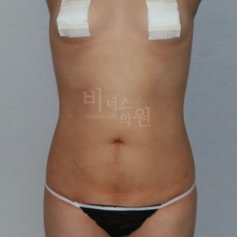복부지방흡입 비용과 수술 범위, 선택 기준 완벽 가이드 — 부천 비너스의원