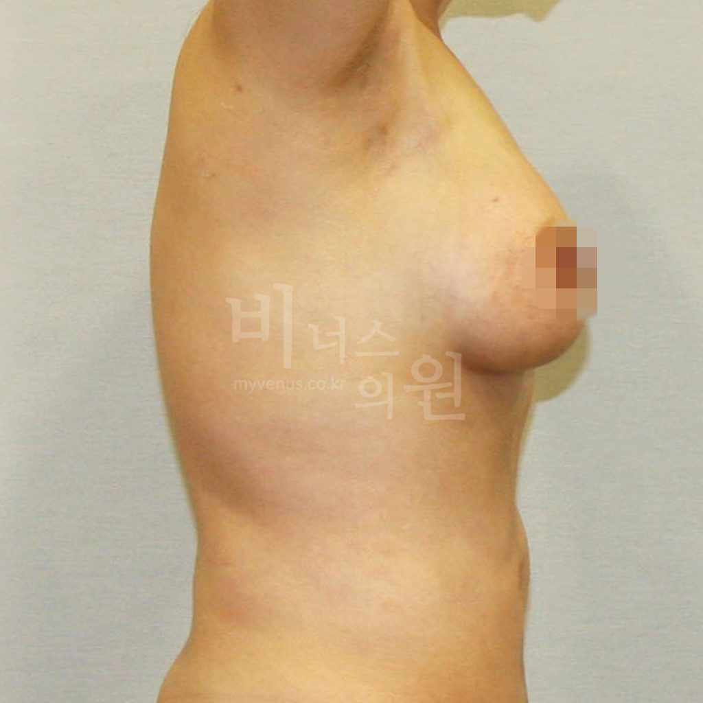 비너스의원 가슴축소 지방흡입 왼측 수술 후