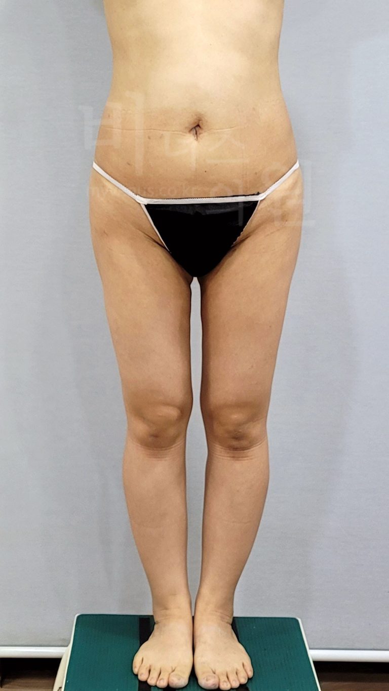 엉덩이축소 비용과 방법 선택 가이드 — 지방흡입으로 만드는 균형 잡힌 힙라인