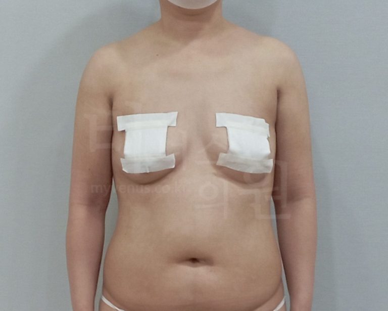팔뚝지방흡입 비용, 얼마가 적당할까? 선택 전 꼭 확인해야 할 것들