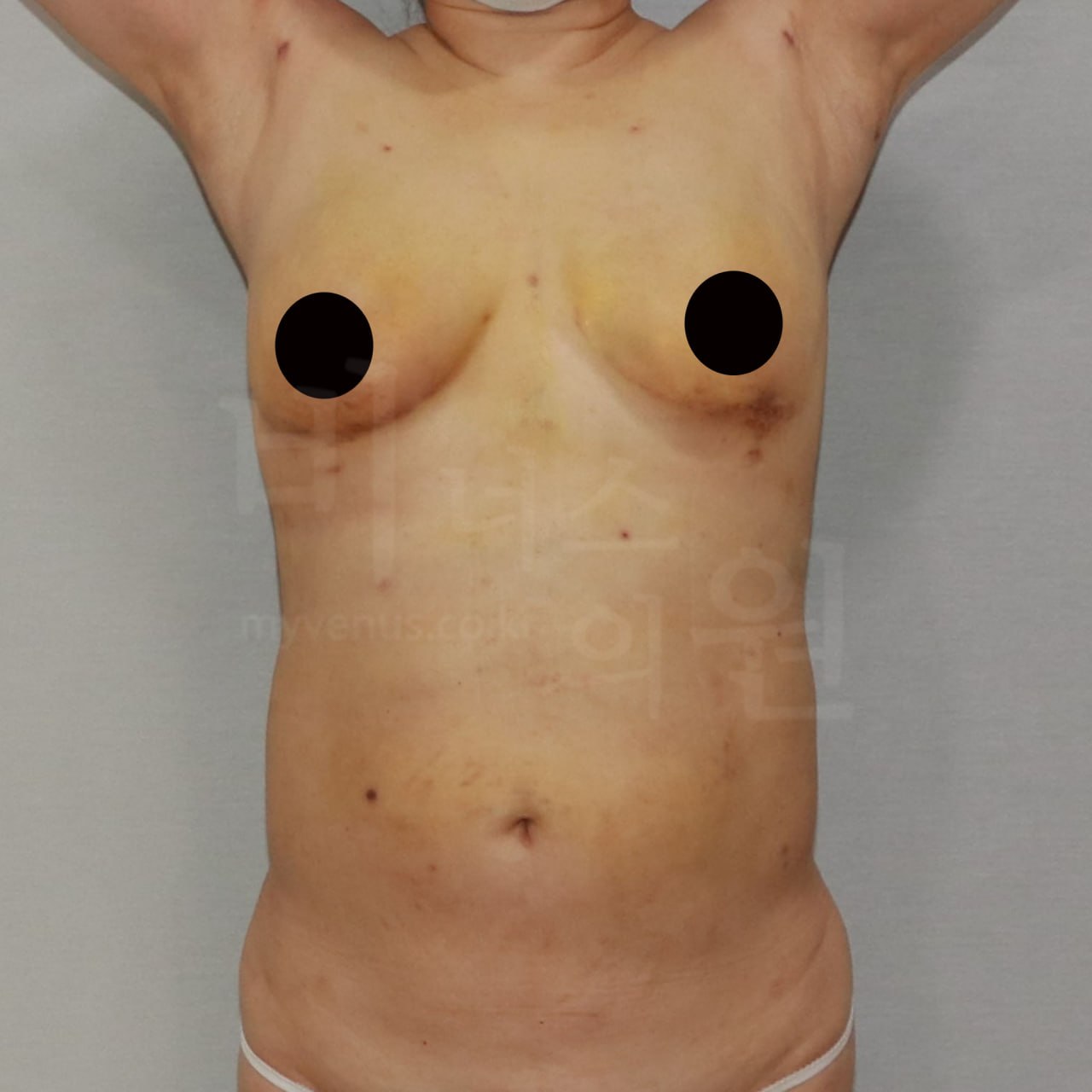 가슴축소 지방흡입 수술 후