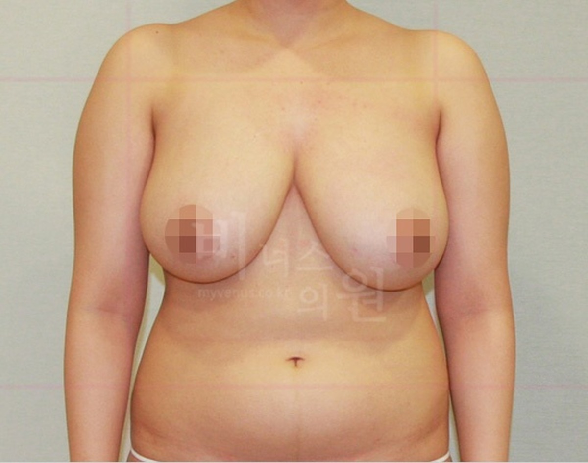 가슴축소 지방흡입 수술 전 정면 사진