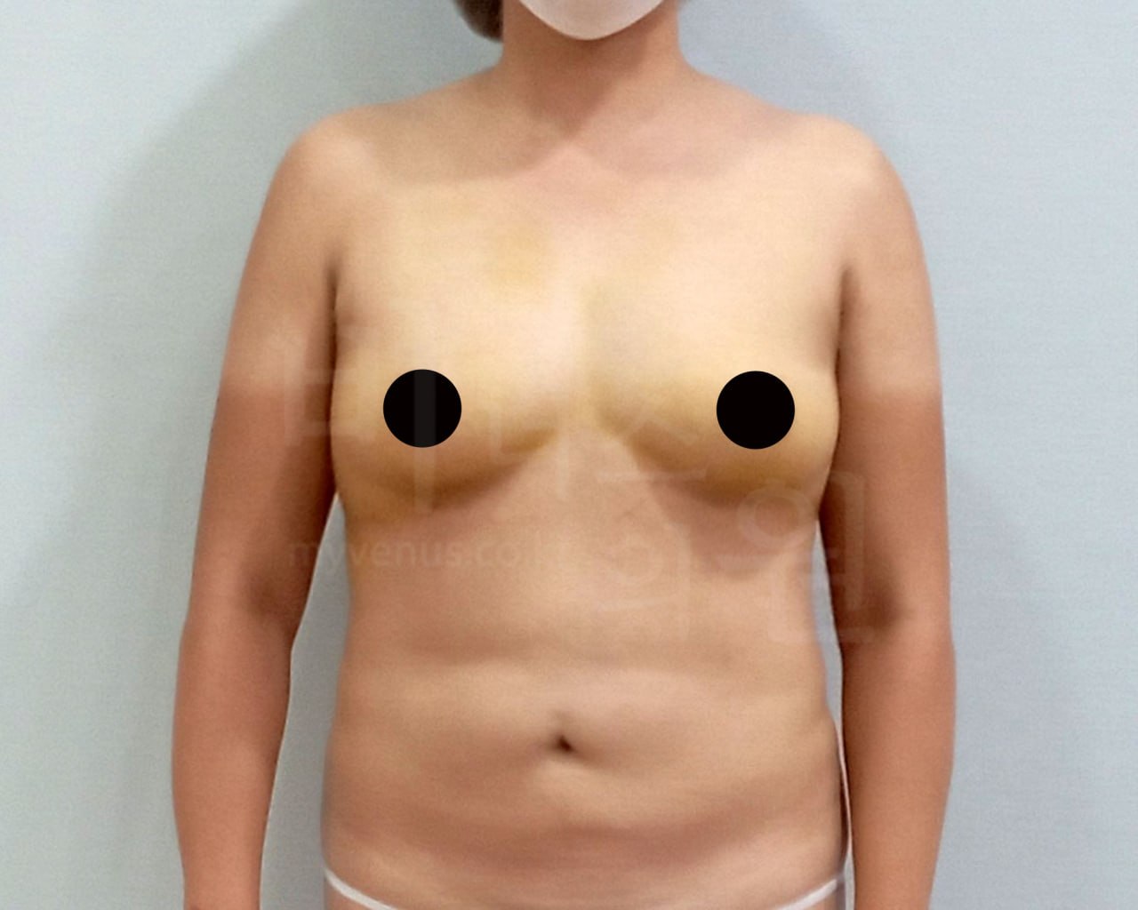 가슴축소 지방흡입 수술 후