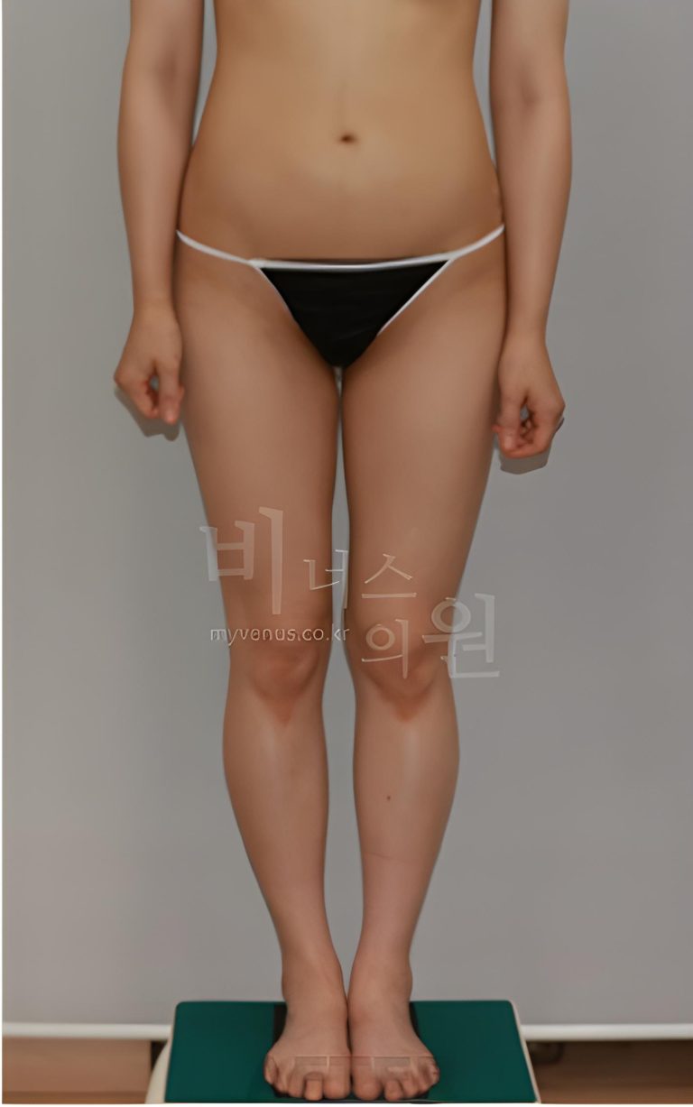 엉덩이축소 상담 전 꼭 알아야 할 것들 — 체형별 적합도, 비용 구성, 병원 선택 포인트