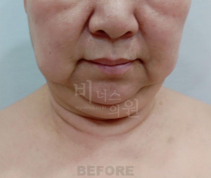 수술 전 1