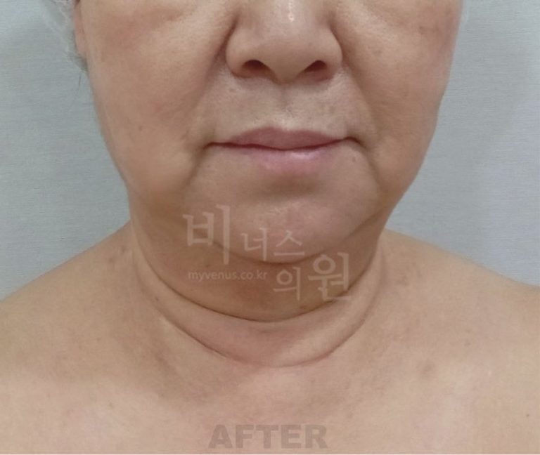 턱지방흡입 비용과 병원 선택 가이드 — 상담 전에 꼭 확인하세요