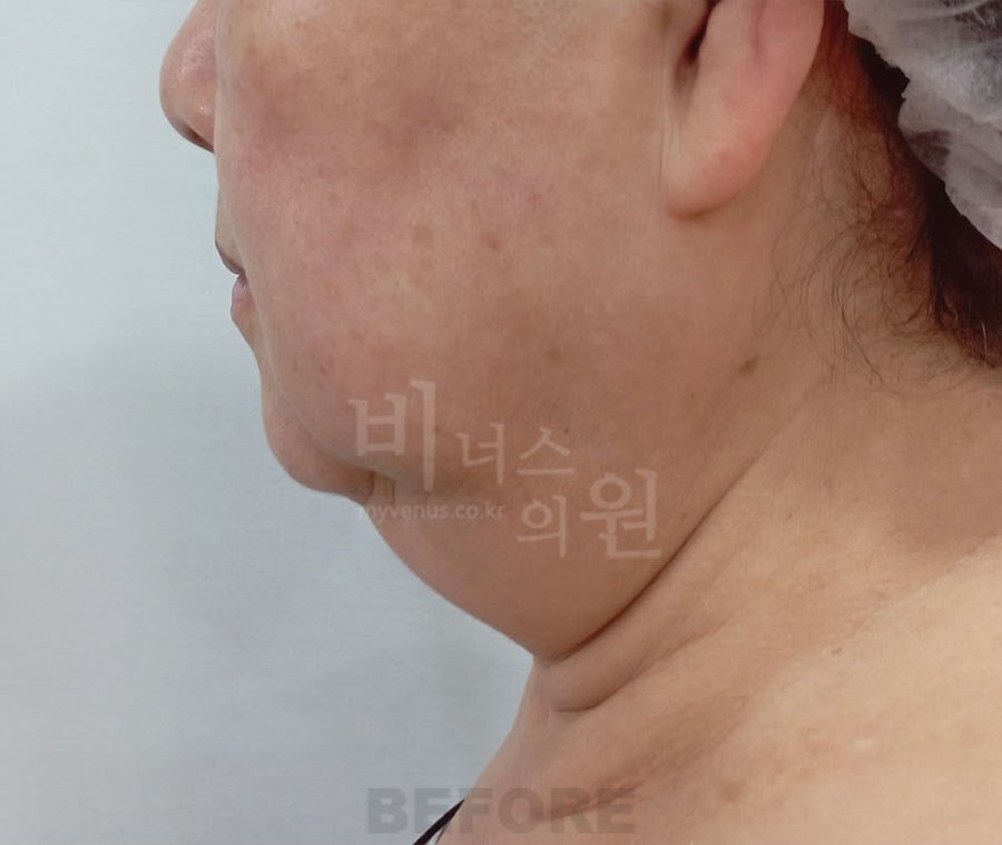 수술 전 2