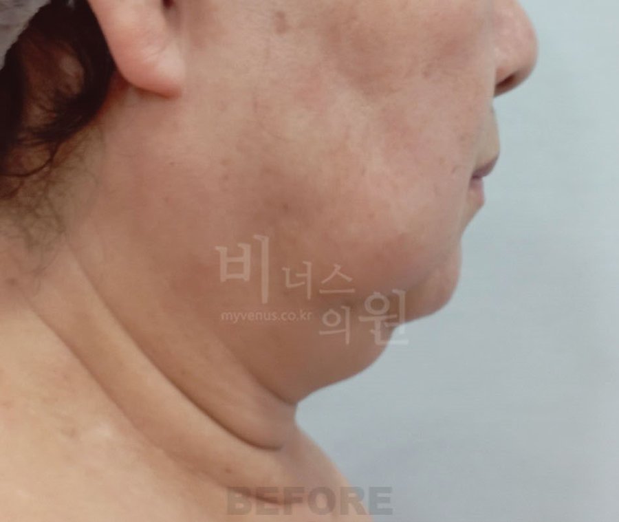 수술 전 3