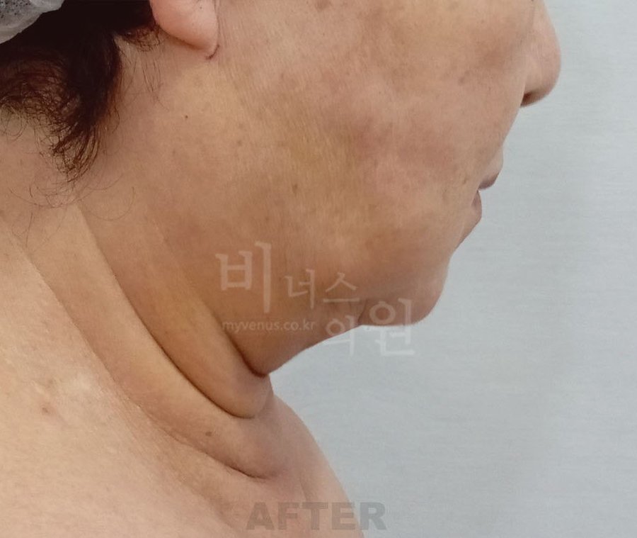 수술 후 3