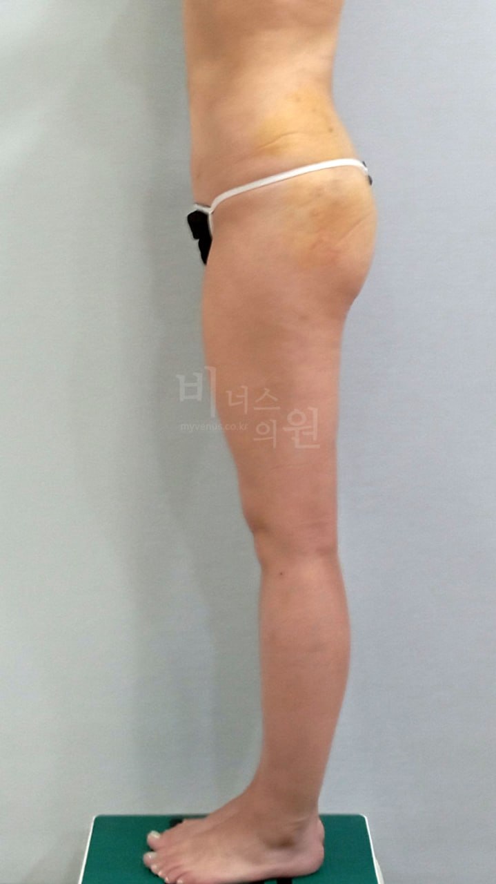엉덩이 지방흡입 수술 후 비너스의원