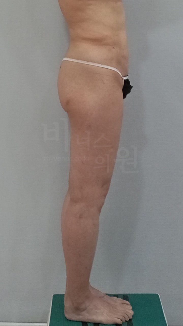 엉덩이 볼륨업 지방흡입 수술 전 측면