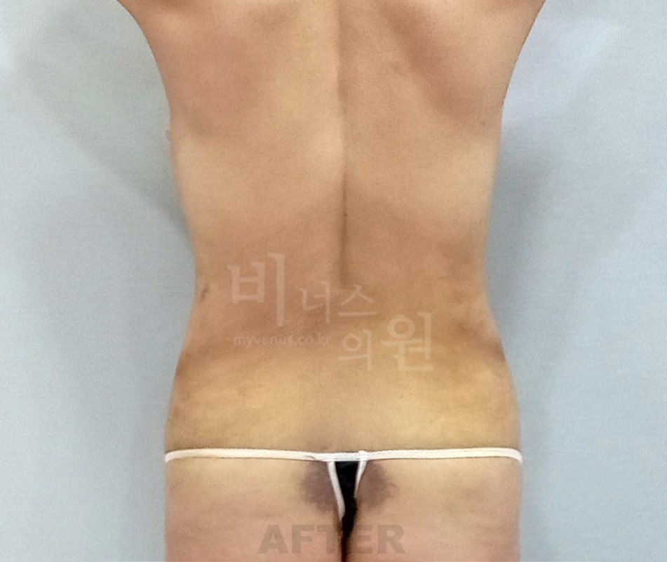 복부 지방흡입 수술 후 후면